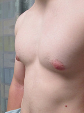 male_breast_reduction